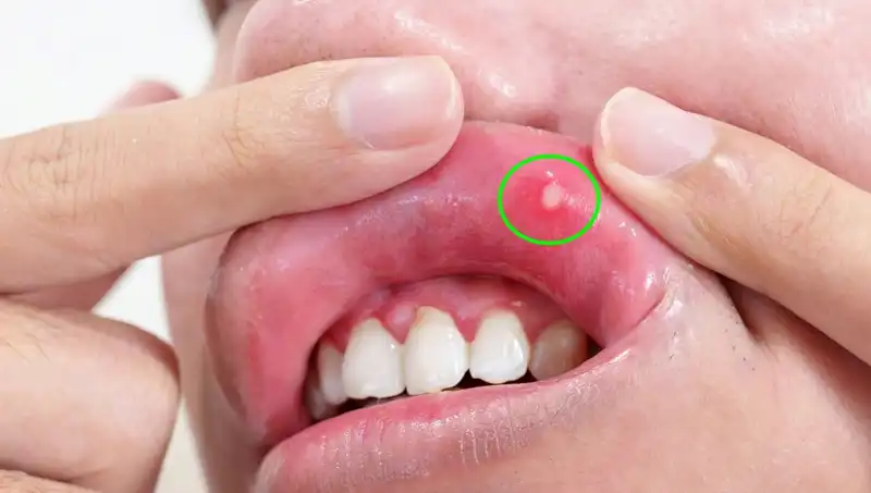 Vücudunuzda B Vitaminleri Eksik Mi? İşte Dikkat Etmeniz Gereken 5 Belirti